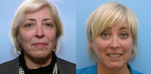 Before-After Surgical Lifting